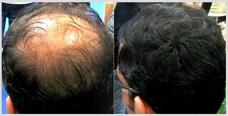 A la caída de los cabello que productos es necesario comer que